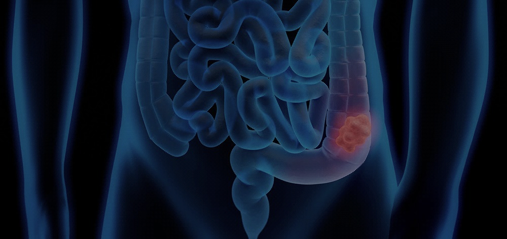 cancer du colon