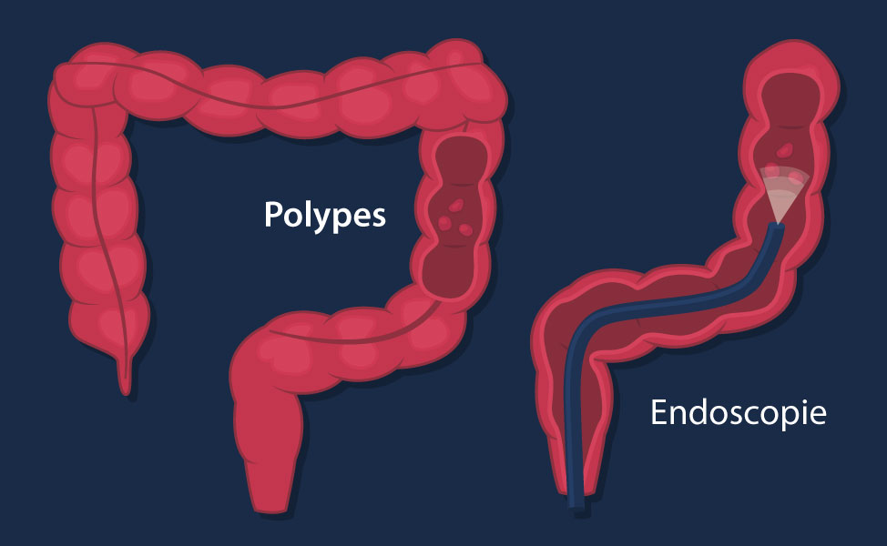 polyps and endoscopy