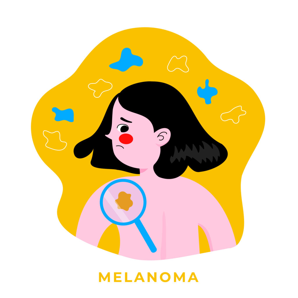 mélanome cancer de la peau