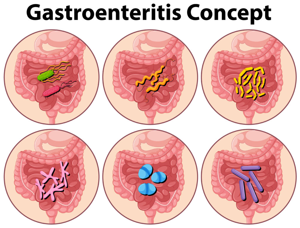 types de gastro-entérite