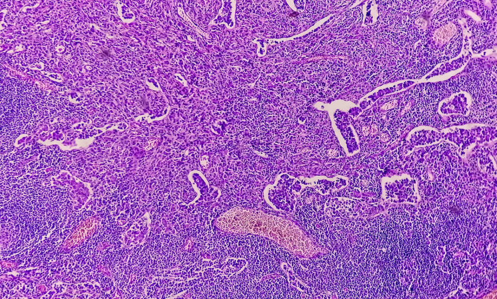 image d'un cancer de l'estomac