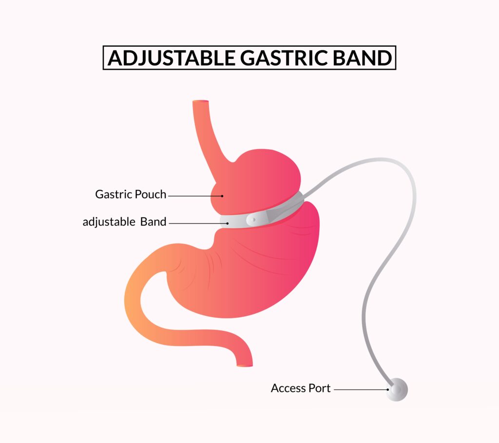 anneau gastrique chirurgie bariatrique