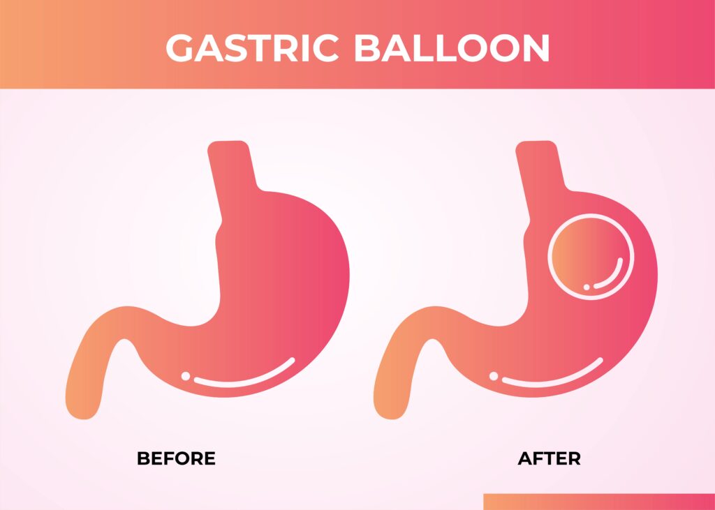 ballon gastrique