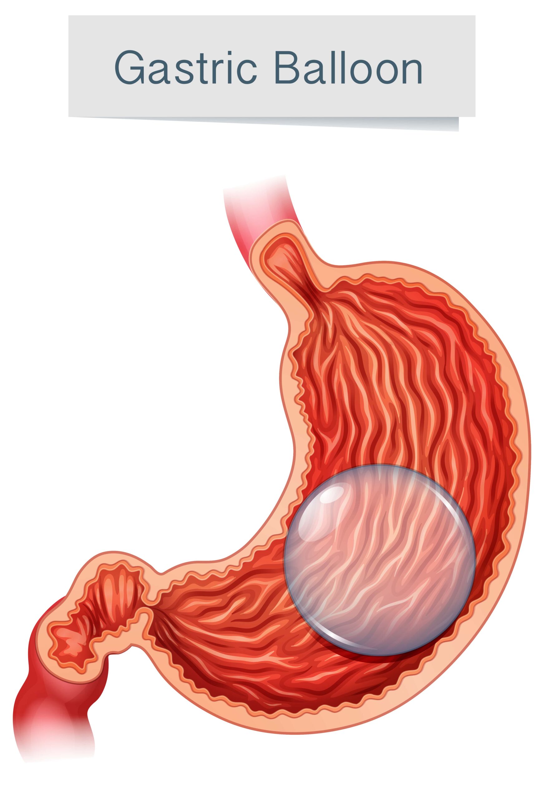 ballongastrique Welliecare — free download