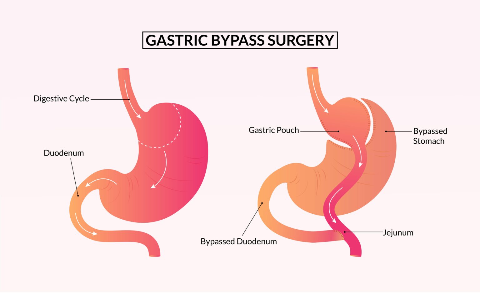 Quelle Chirurgie Digestive Choisir Pour Perdre Du Poids quelle-chirurgie-digestive-choisir-pour-perdre-du-poids