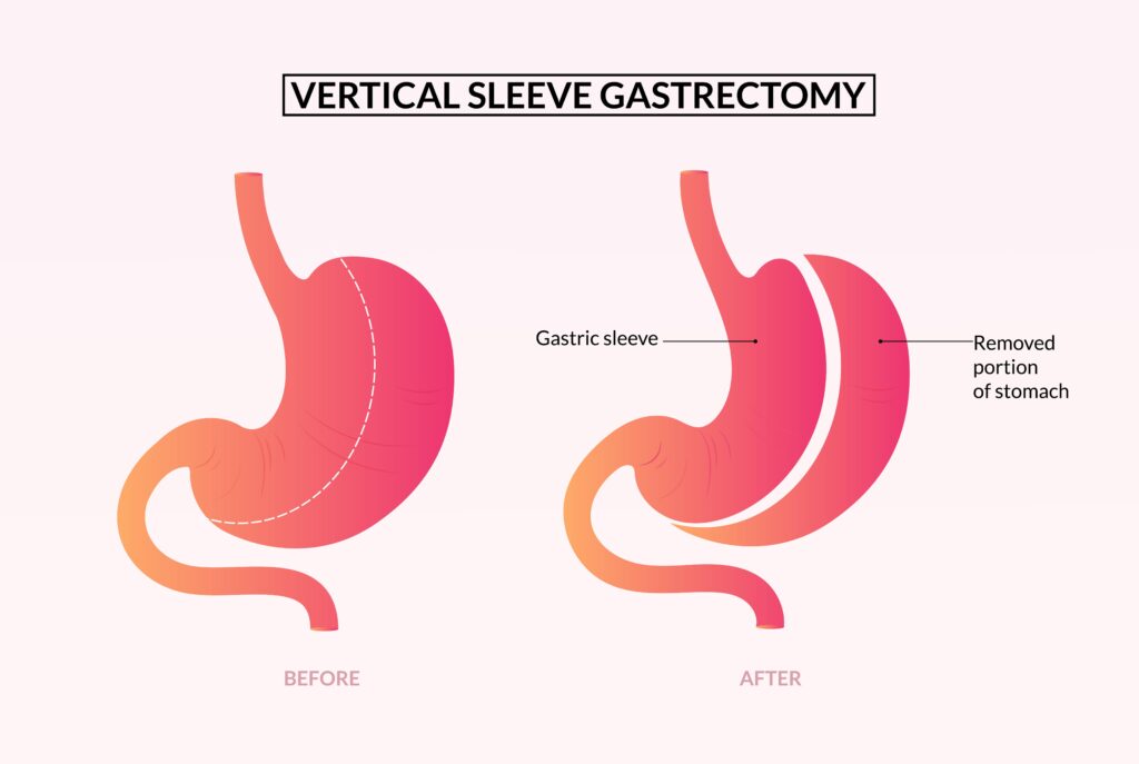 sleeve gastrectomie verticale
