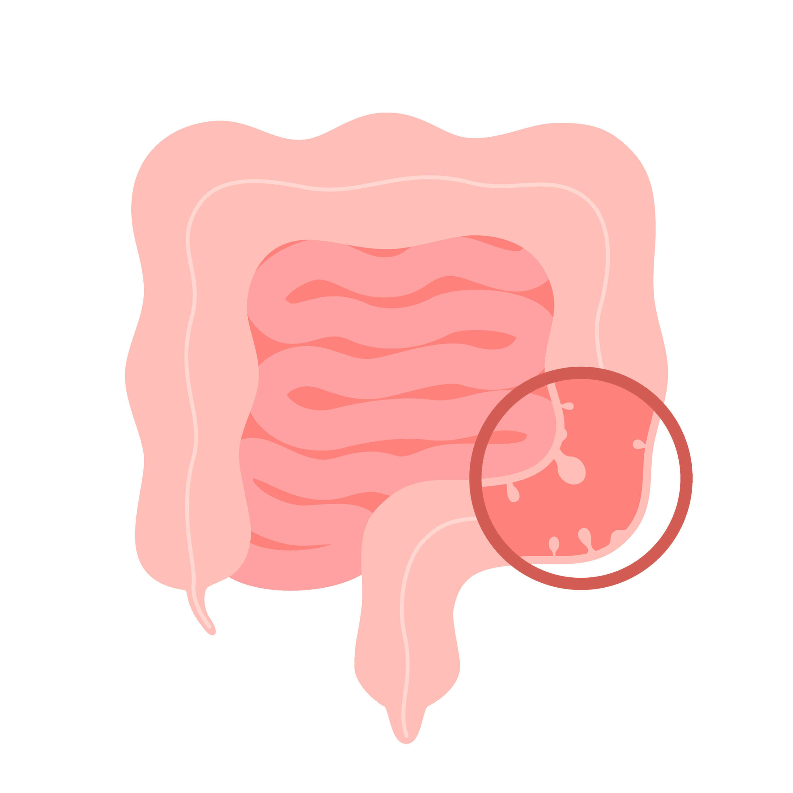 polypes intestinaux