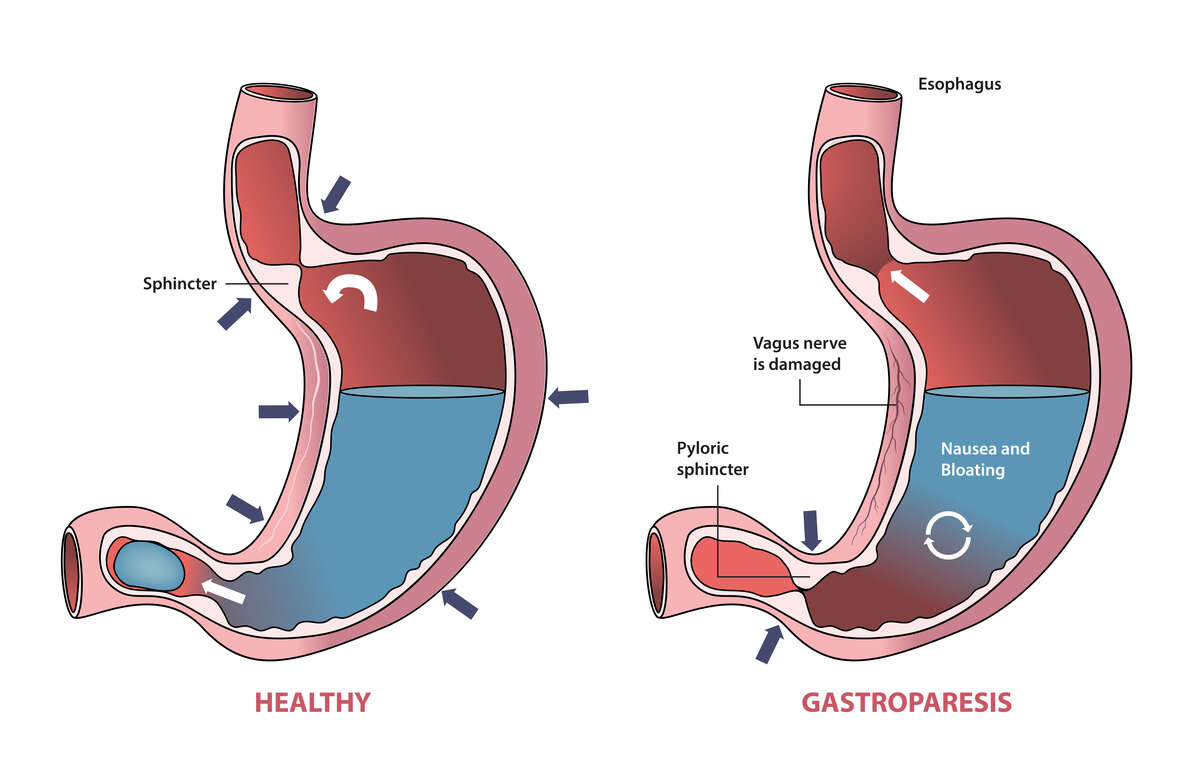 gastroparesis