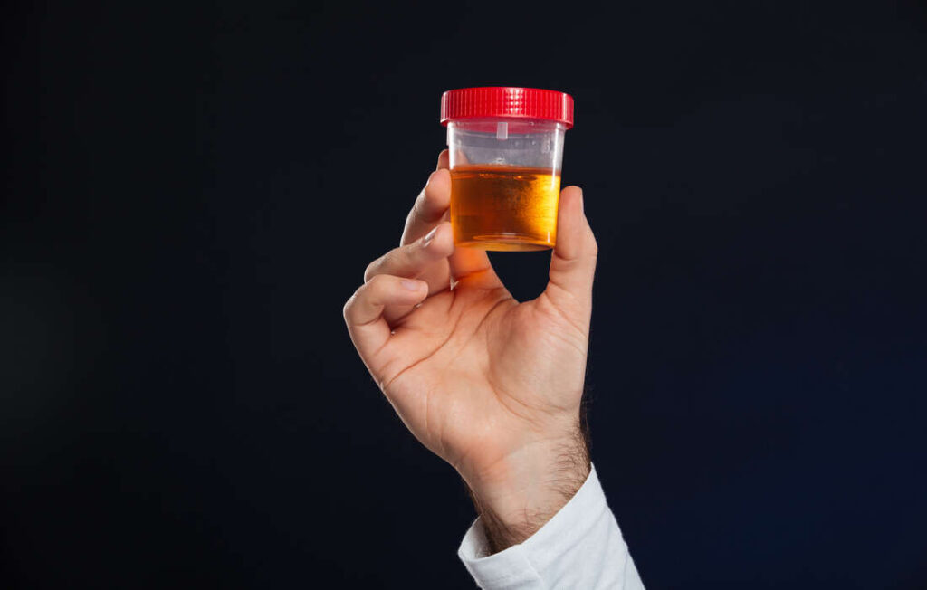 cause des urines foncées