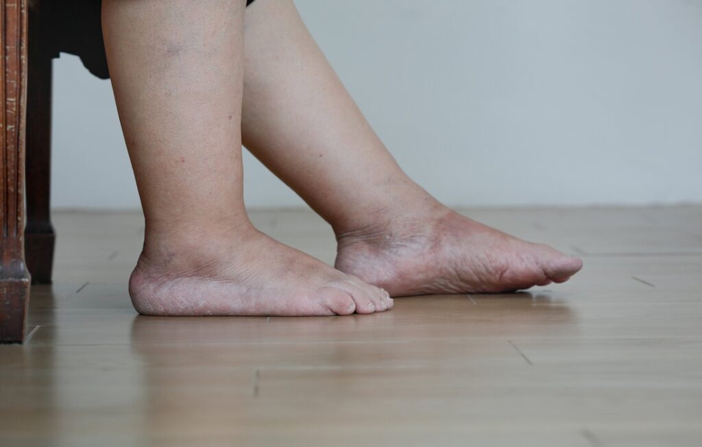 Symptômes Courants du Pied Diabétique 