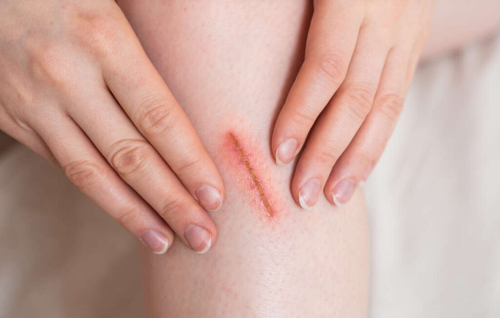 diabète et cicatrisation