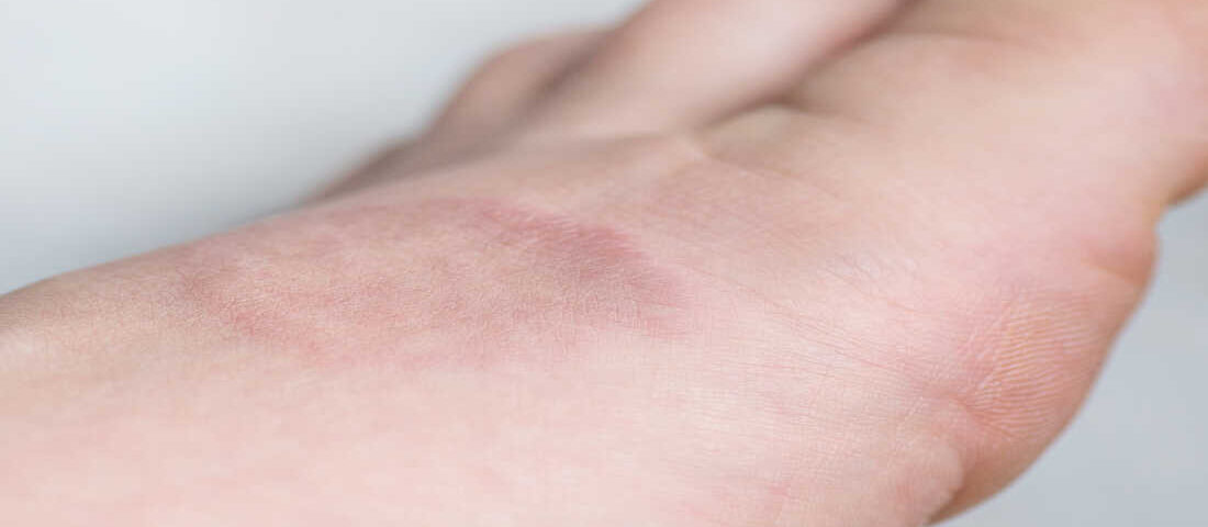 piqure de puce